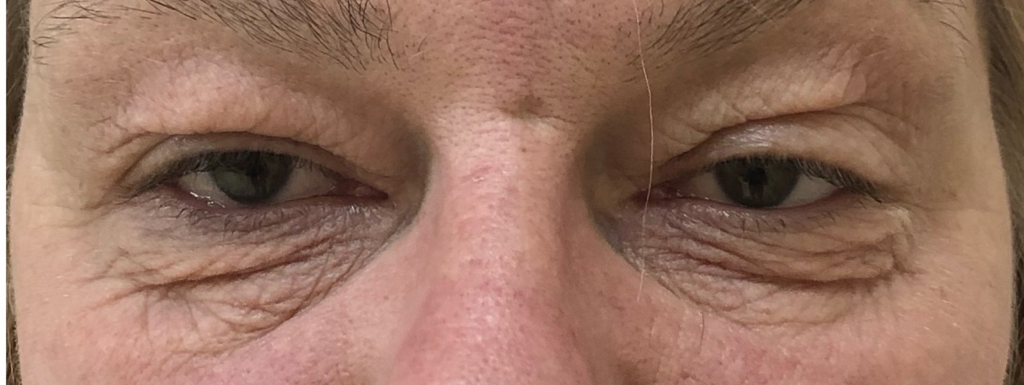 нависание век, мешки под глазами