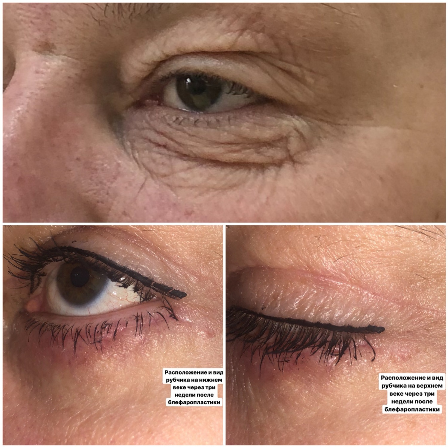 где распологаются рубцы после блефаропластики